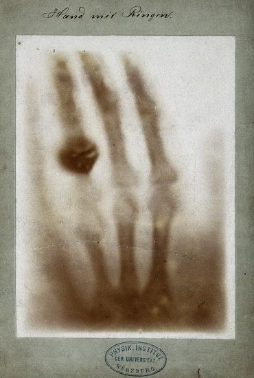A röntgen sugarak felfedezése Conrad Röntgen 1895, Röntgen Zürich-bentanult, hallgatta Clausiuskinetikus gázelméletről tartott előadásait. August Kundtfigyelt fel a tehetségére.