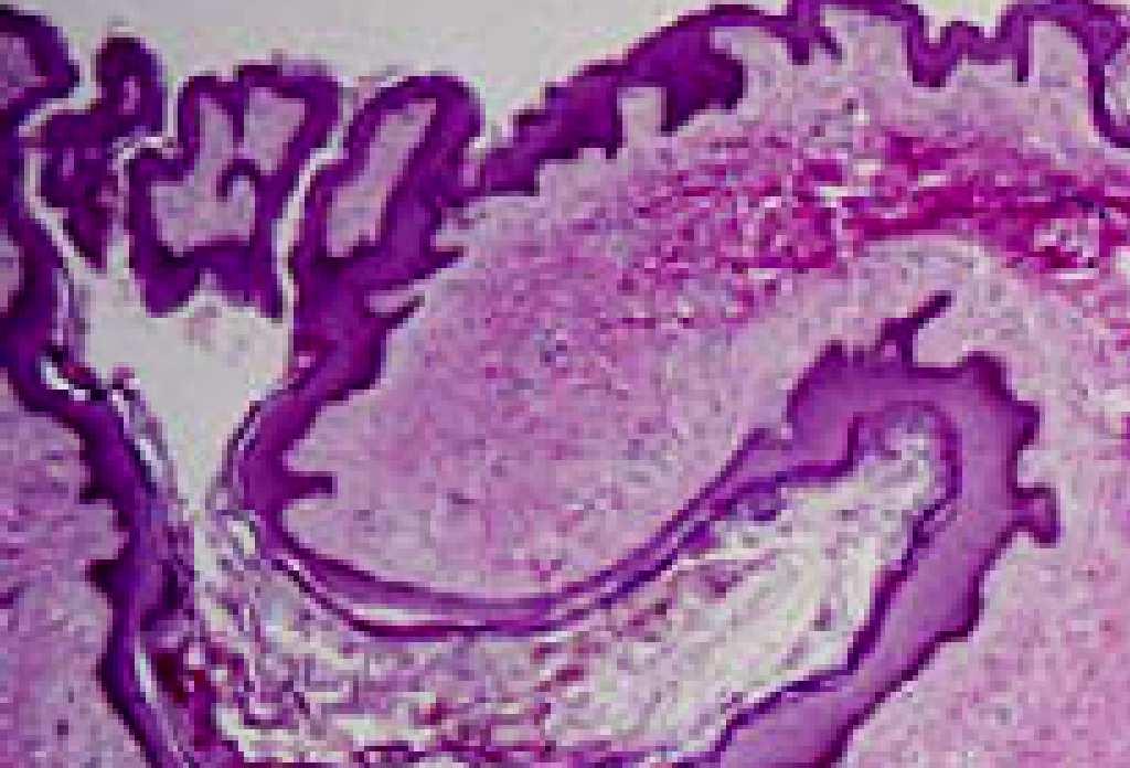 Pathomechanizmus Többszörös nyílással rendelkező comedo korai jel Folliculus epithelium elváltozásai megelőzik az