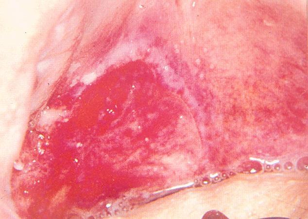 Erythroplakia Queyrat Élénkpiros, bársonyos, enyhén a nyálkahártya szintje alatt Hátterében hámdysplasia, in
