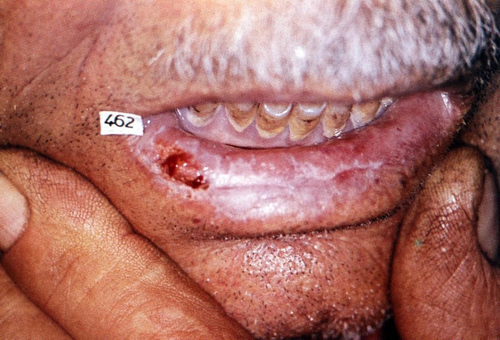 Cheilitis chronica actinica Cheilitis solaris Alsó ajkon jön létre napfény-expozició hatására, főként férfiakon A hám elvékonyodik, kóros pigmentáció, fájdalmas