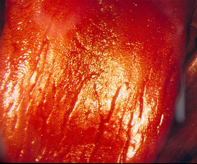 Vashiányos anaemiás glossitis (Depapillált, fénylő, sima nyelvhát, leukoplakia