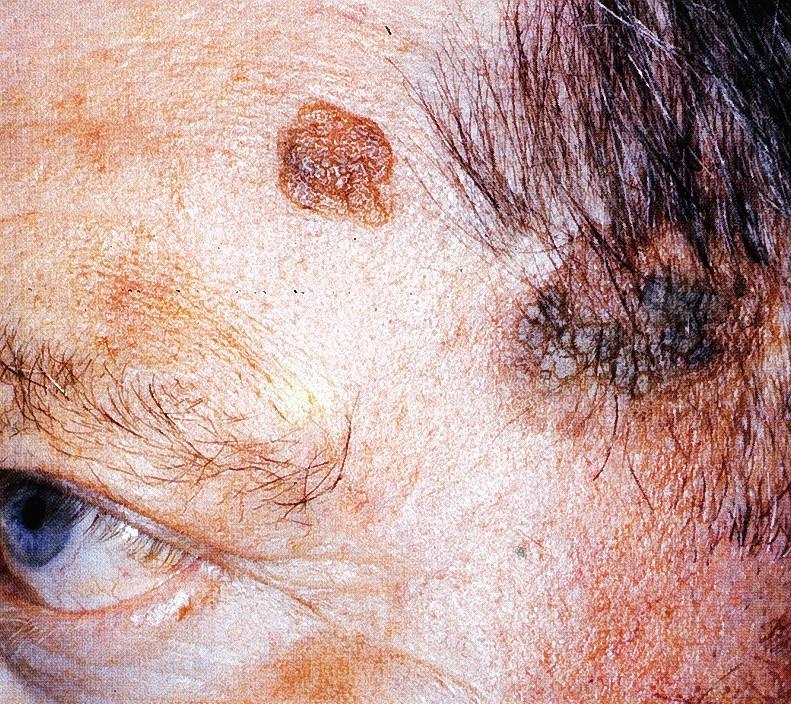 Keratosis seborrhoica Keratoma senile Ismeretlen eredetű hámburjánzás, mely idős emberek arcbőrén jelenik meg Solitaer vagy többszörös