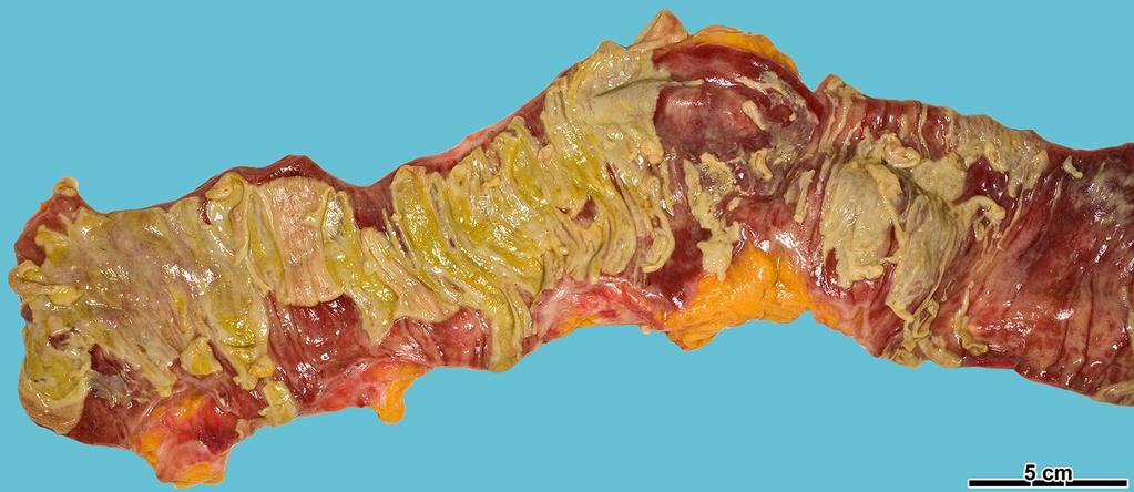 Fulmináns Clostridium difficile colitis: a vastagbél