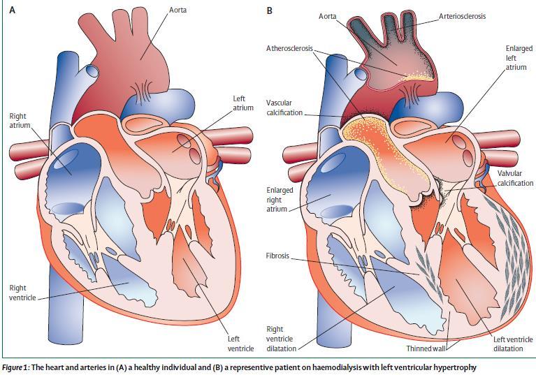CRS-IV: reno-cardialis syndroma