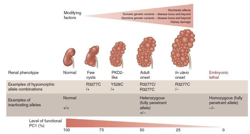 Az ADPKD