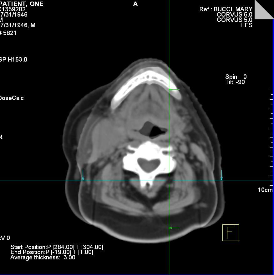 Képvezérelt sugárkezelés = Image-guided radiotherapy (IGRT) Cél: a napi beállítási pontatlanságból, a kezelés alatti anatómiai változásokból és a belső szerv