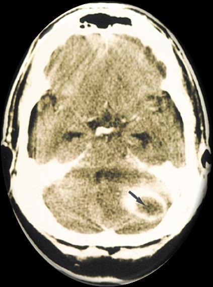 Sinus sigmoideus thrombosis Petrositis