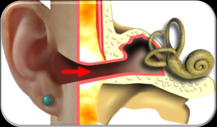 labyrinthitis: izgalmi tünetek (nystagmus a beteg oldalra, Webert a beteg fülbe lat.