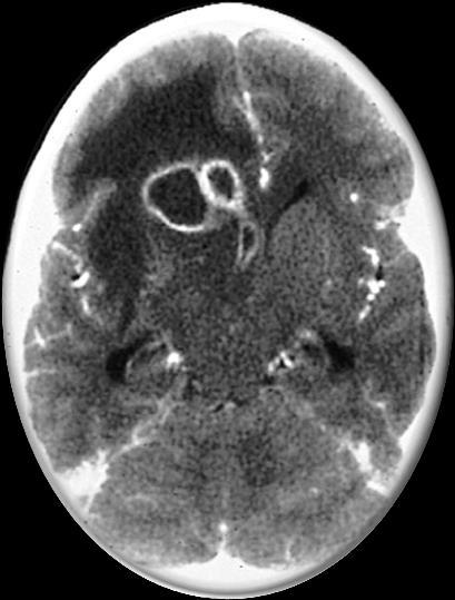 Osteomyelitis