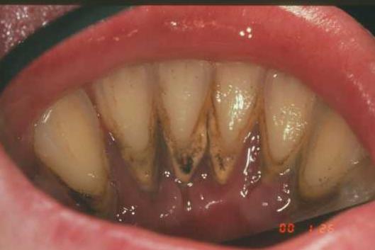 Instruáció és motiváció Etiológiai faktorok eliminálása Fogorvos, Dentálhigiénikus Biofilm, dentális plaque - causal