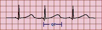 Long QT Szindróma (LQTS) a korrigált QT időtartam (QTc) megnyúlása EKG-en (nőknél >460ms,