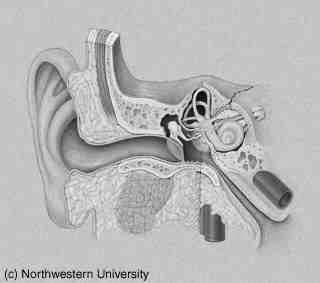 Meniére-betegség Tünetek: fülzúgás, rohamokban jelentkező szédülés, perceptiós halláskárosodás. (P. Meniére, 1861) Oka: az endolympha túltermelése ill.
