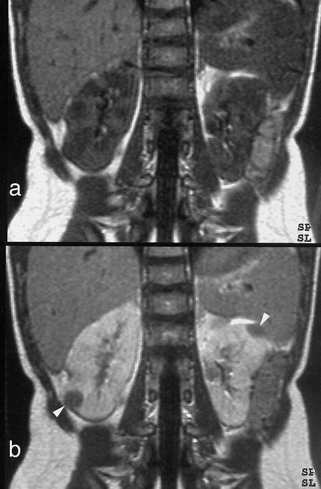 KÉPALKOTÁS Multifocalis típus: - a nephrogen maradvány