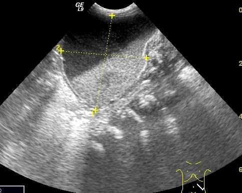 OVARIALIS TERIME Az újszülött ovarium normálisan is több 2-10 mm cystát tartalmaz Kb.