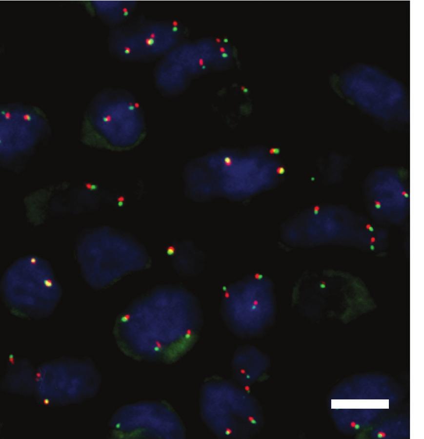 AZ ALK-POZITÍV TÜDŐRÁK DIAGNOSZTIKÁJA 305 a b 1. ÁBRA. ALK-génátrendeződés kimutatása sebészi mintán fluoreszcens in situ hibridizációs módszerrel (Vysis ALK FISH-kit).