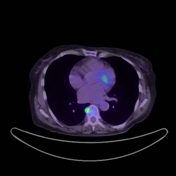 Jelen Egységes utánkövetési protokollok kollok: csontáttétek korábbi felismerése Modern diagnosztika (PET-CT, teljes test MR,, CT stb.