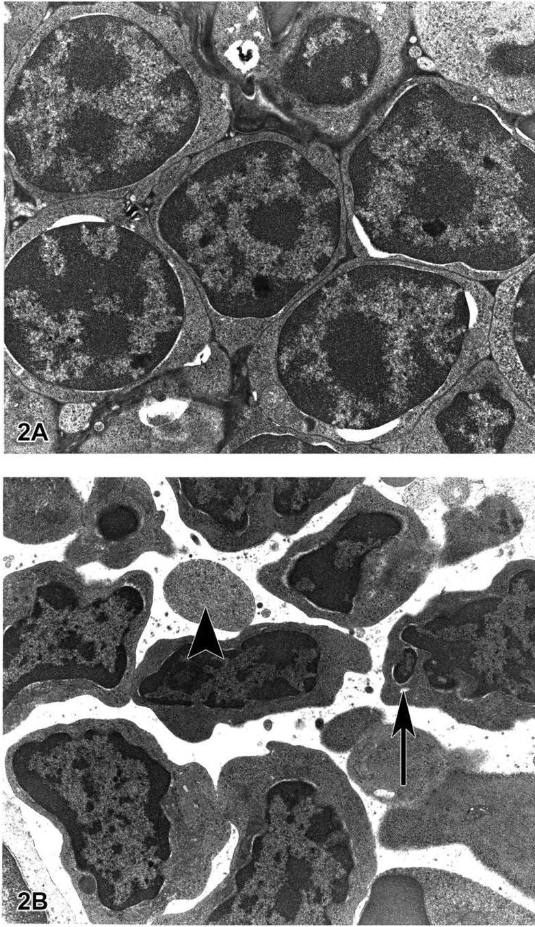 Thymus: A: normál thymus B apoptozis korai szakasza limfocitákba.