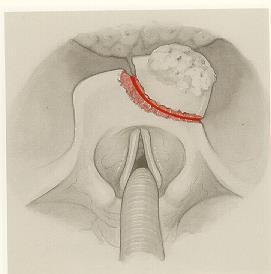 Endolaryngealis epiglottectomia, supraglotticus horisontalis gégeresectio Kis T1 epiglottis