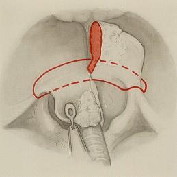 Endolaryngealis epiglottectomia, supraglotticus horisontalis gégeresectio Műtéti technika: Előrehaladott, nagy