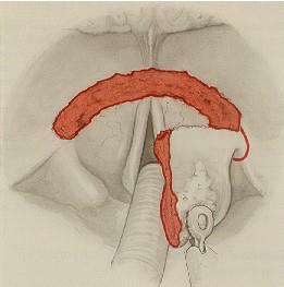 Endolaryngealis epiglottectomia, supraglotticus horisontalis gégeresectio Műtéti technika (folytatás): A második metszés a valleculában vagy