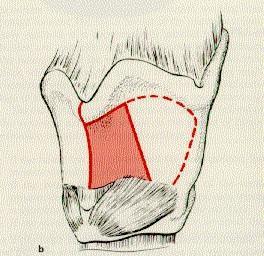 Resectio partialis frontalis (anterior) et fronto-lateralis laryngis Frontális (anterior)