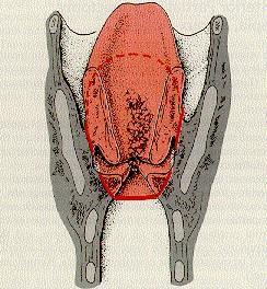 Resectio partialis frontalis (anterior) et fronto-lateralis laryngis Frontális (anterior) részresectio Tapia,