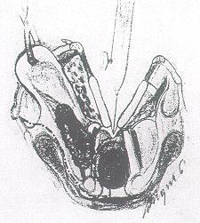 Czigner-féle primeren zárt verticalis subtotalis gégeresectio Műtéti technika: tracheotomia, gége előtti izmok átvágása az érintett oldalon, pajzsporcon fűrésszel ferde metszés.