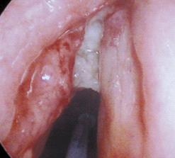Supracricoid horisontalis laryngectomia crico-hyo-(epiglotto)-pexiával Műtéti indikáció: Válogatott T2-T4 glotticus vagy