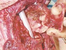 Supracricoid horisontalis laryngectomia crico-hyo-(epiglotto)-pexiával Műtéti technika: Feltárást követően a garatfűző izmok és sinus piriformis leválsztása mindkét oldalon a