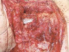 Supracricoid horisontalis laryngectomia crico-hyo-(epiglotto)-pexiával Műtéti
