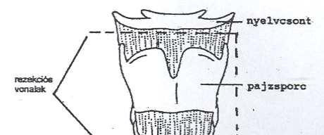 Részleges gégeműtétek utáni megváltozott anatómiai viszonyok 5.