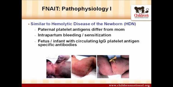 Neonatalis Alloimmun Thrombocytopenia (NAIT) Magzati thr ag az anyát imm-ja, anyai at a magzat thr-jének pusztulását okozza vvs ÚHB Első leírás 1950.