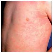 sjia - AUTOINFLAMMATORIKUS kórkép Szisztémás tünetek dominálnak, az ízületi gyulladás nem vezető tünet Intermittáló magas láz + a bőrtünetek (rash) hetekkel, vagy akár