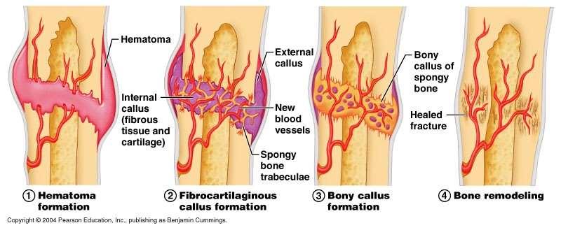 A csont regenerációja során kezdetben a szöveti folytonosságot egy kötőszövetes heg biztosítja, amely először fonatos csontszövetté alakul, majd ez lemezes