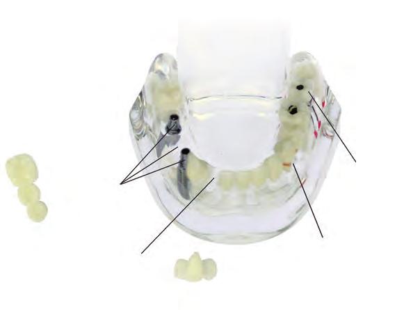 híd Szemléltető modell (KKD) Tanulmánymodell fogbetegségek, implantátum munkák, hidak, koronák, inlay-k szemléltetésére.