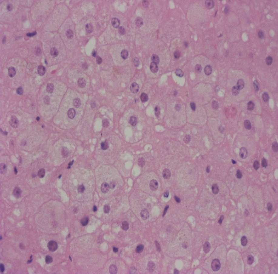 Szövettan...liver necrosis, fatty degeneration and apoptosis......drug-toxicity? 103 cases 18% Portmann B. Liver allograft pathology and biopsy interpretation.
