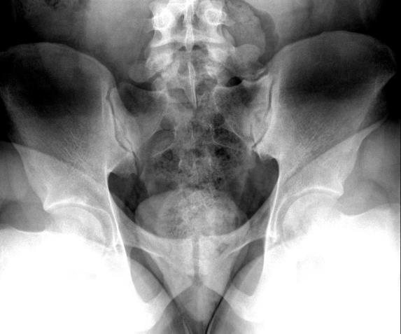 2.ábra Normális sacroiliacalis ízület röntgenképe (balra) és III-IV. stádiumú sacroiliitis röntgenképe csak helyenként követhető ízületi réssel (jobbra).