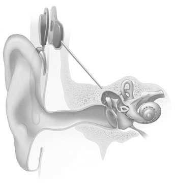 A hallássérülés hatása a beszédre 109 tó. Léteznek már szemüvegszárba épített készülékek is; illetve olyanok, amelyeket sebészileg ültetnek a fül mögötti csontba.