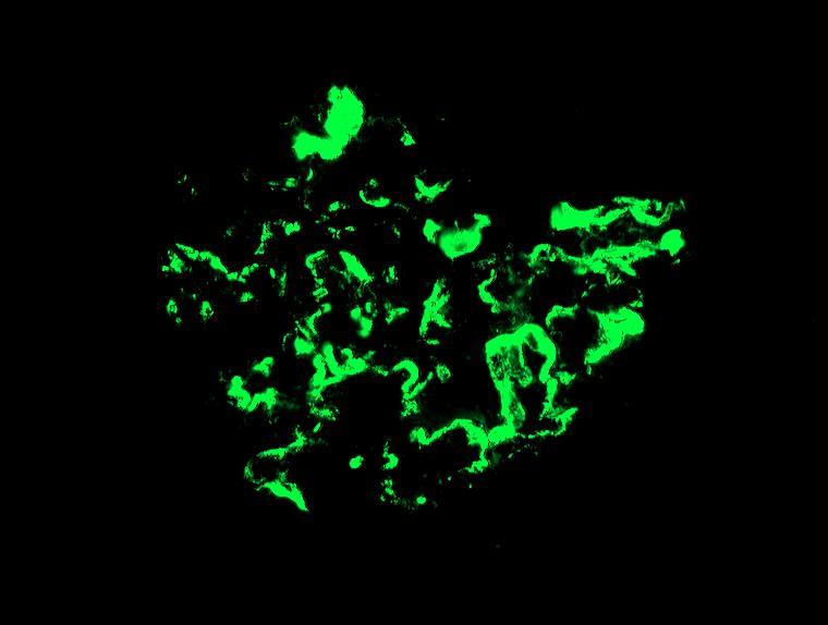 IgA nephropathia (Berger-kór) immunfluoreszcens képe