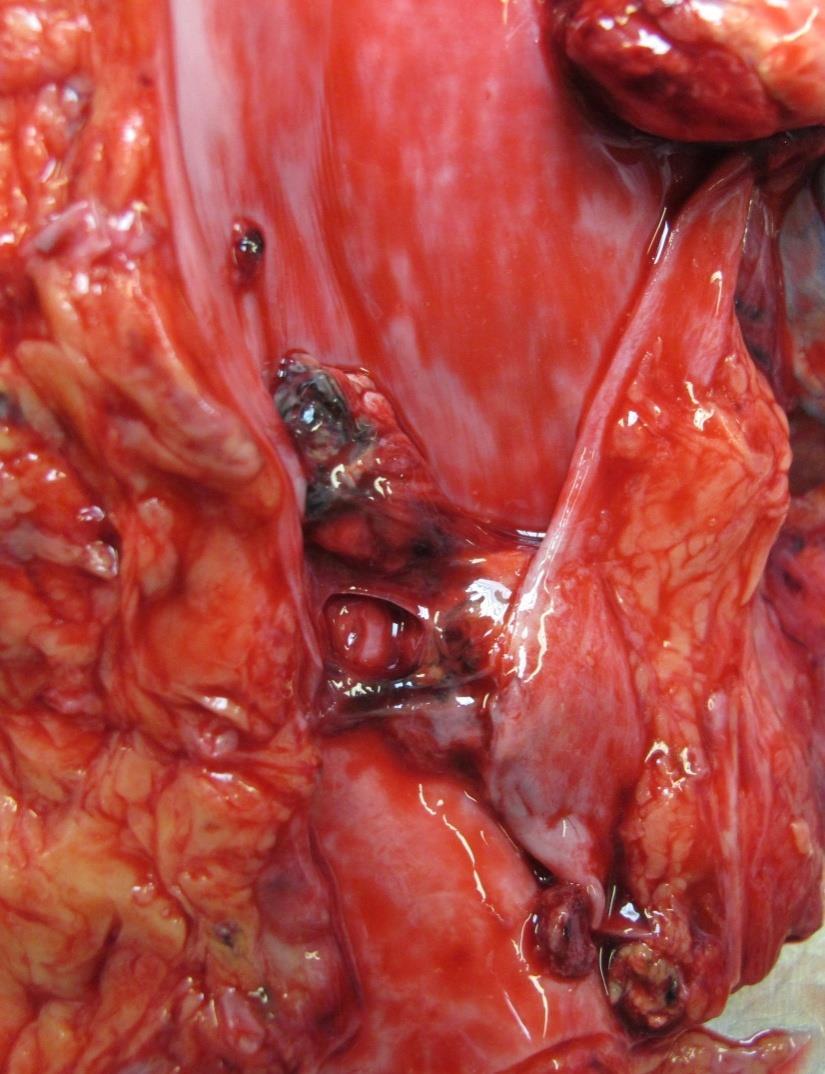 Világossejtes vesecarcinoma stádium-meghatározásának alapja Tumor mérete Vesevénába terjedés Vesemedence szöveti állományába