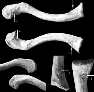 1: ligamentum costoclaviculare, 2: m. deltoideus 5. ábra: Sárrétudvari széria csontjainál megfigyelt főbb elváltozások jelölve a kulcscsonton (5. sír). Fig.