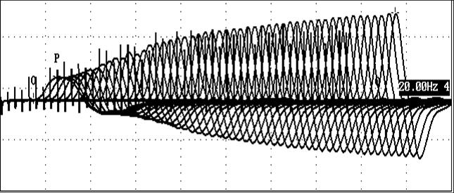 Myasthenia gravis 3 Hz