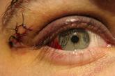 Szemhéj sérülések Contusio (véraláfutás) Laceratio (kisebb repesztett sebek) Miért kell szemészhez fordulni?