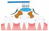 Speciális fogkefék Az IONIC KISS egy egészségtudatos fogkefecsalád, amely amellett hogy hatékonyan távolítja el a lerakódott plakkot, a fogszuvasodás és a lakosság 80-90%-át érintő fogágybetegségek
