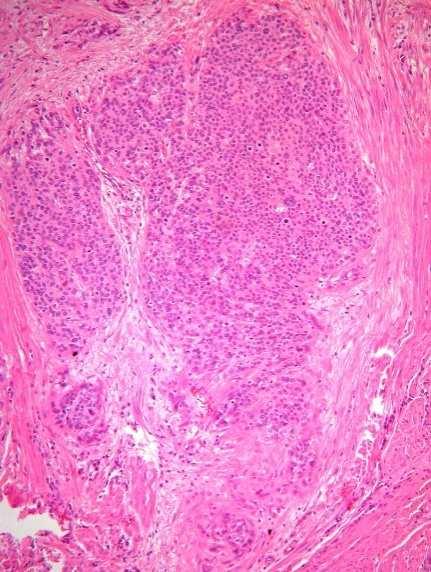 Az anogenitálistraktus laphámtumorainaketiológiája HPV-asszociált Fiatal: < 40-50 év Preinvazív elváltozások: LSIL; HSIL Invazív carcinoma általában rosszul differenciált Etiológiai faktorok: Korai