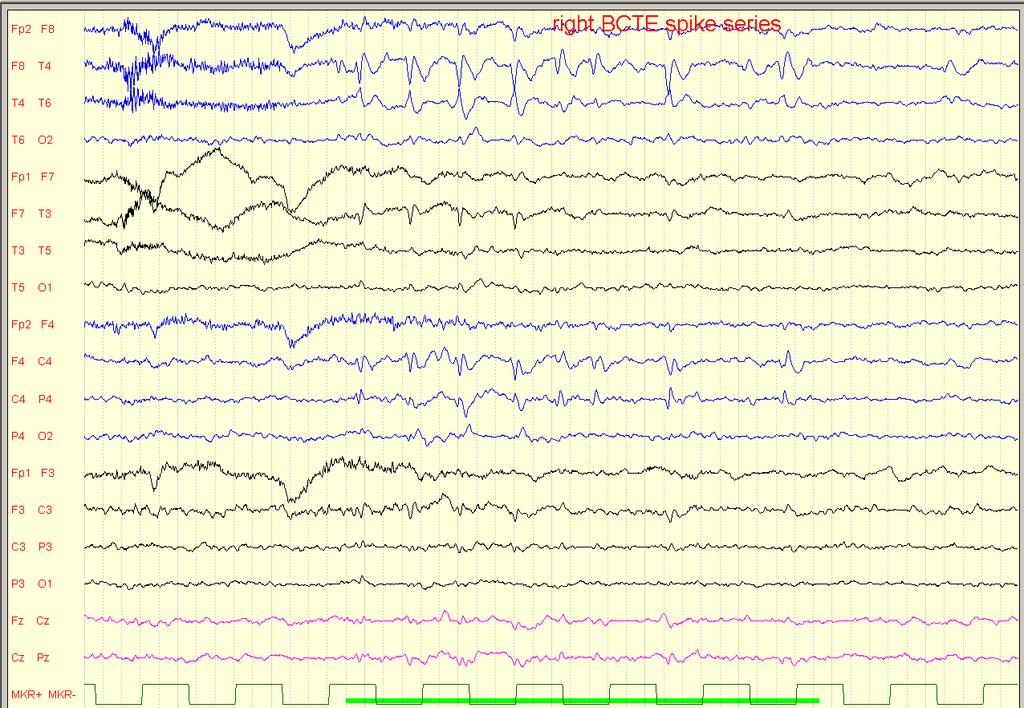 Fokális epilepszia Benignus centrotemporális epilepszia indulás: 3-8 év