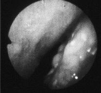 13. ábra:vpi endoszkópos képe: a lágy szájpad nem zár a hátsó garatfalhoz komponensének százalékos arányát adja meg.