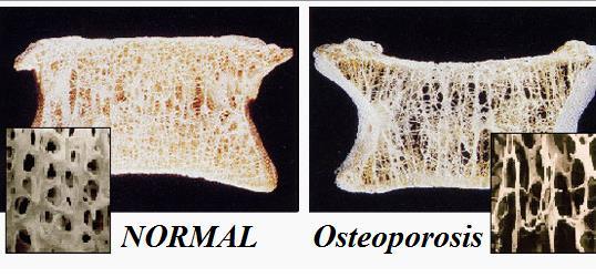 I. Osteopenia 1 Leggyakrabban