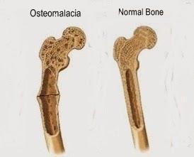 I. Osteopenia 2