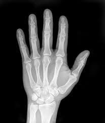 Hagyományos röntgen A csontok anatómiai ábrázolásra kiváló Messzemenően a leggyakrabban használt modalitás Olcsó, könnyen elérhető A röntgensugár